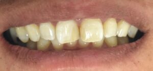 前歯の色のくすみと形の不揃いが気になる症例(ホワイトニング・ダイレクトボンディング前/40代男性・大阪北新地)