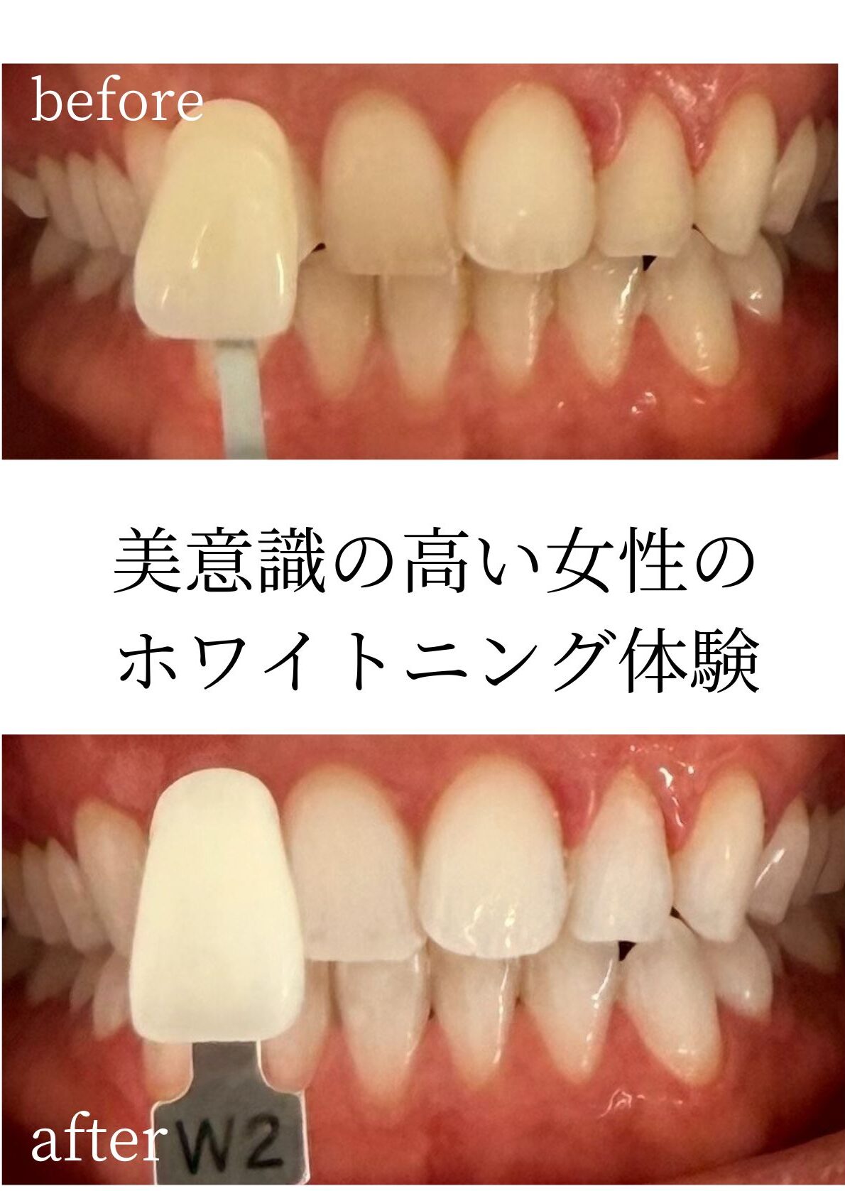 30代女性のオフィスホワイトニング術前と術後