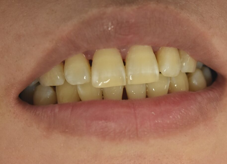 ホワイトニングで歯の黄ばみが改善したアフター