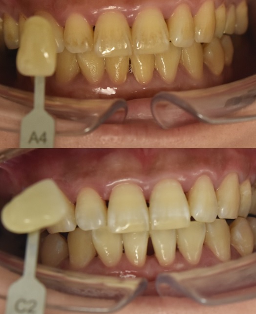 セルフホワイトニングで効果を感じなかった方のオフィスホワイトニング症例