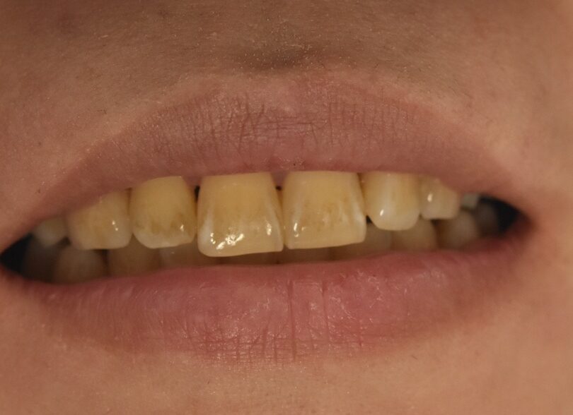 ホワイトニングで歯の黄ばみを改善する前の口元