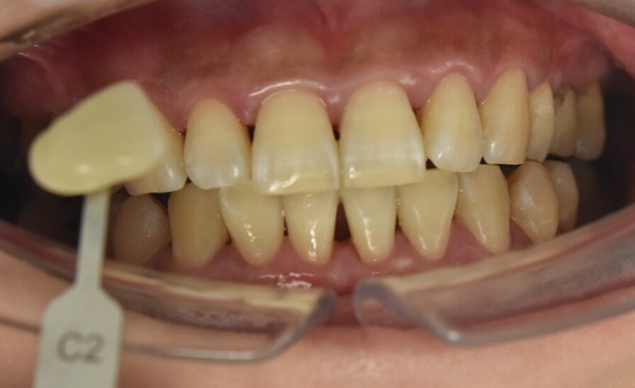 歯の着色と黄ばみがホワイトニングで改善した症例写真