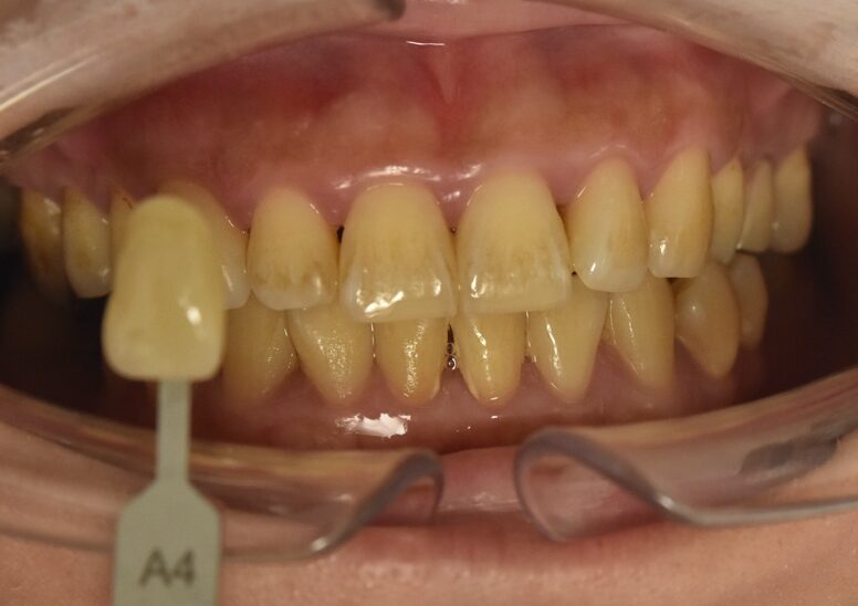 歯の着色と黄ばみがホワイトニングで改善する前の口元写真