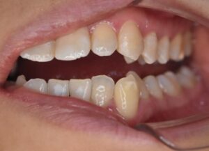 アイコン治療とダイレクトボンディングを併用したケース治療後