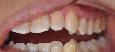 ホワイトスポット治療後の歯の状態（アイコン治療＋ダイレクトボンディング後）