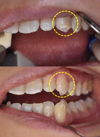 ホワイトスポット治療前の歯の状態（アイコン治療・ダイレクトボンディング前後）