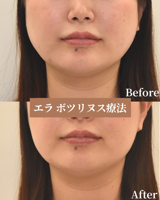 エラ ボツリヌス療法で小顔＆食いしばり改善｜30代女性症例紹介（大阪・北新地）