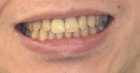 前歯の古い差し歯と歯茎の黒ずみが見られる治療前のスマイルラインの状態