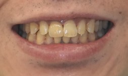 前歯の古い差し歯と歯茎の黒ずみが見られる治療後のスマイルラインの状態