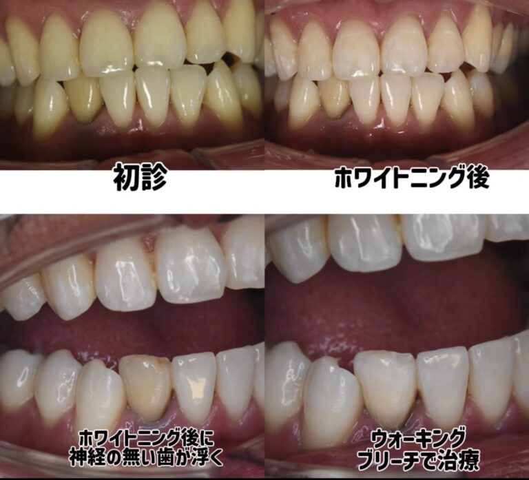 ホワイトニング後に神経のない歯の色が気になる？ウォーキングブリーチで自然な白さへ