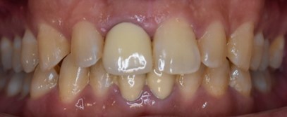 前歯の古い差し歯と歯茎の黒ずみが見られる治療前の状態