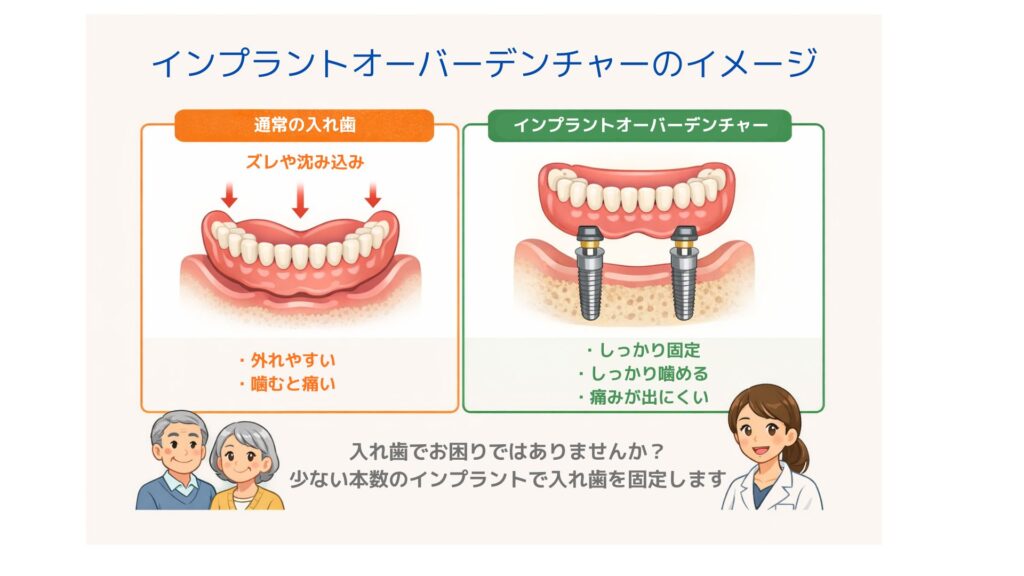 総入れ歯とオーバーデンチャーの比較イメージ