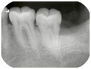 手前の歯に虫歯を作った横向き親知らずの抜歯症例の術後