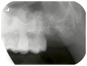 左上下の親知らず抜歯前のレントゲン画像