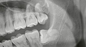 北新地で親知らずが腫れた方へ受診の目安を解説したイメージ画像