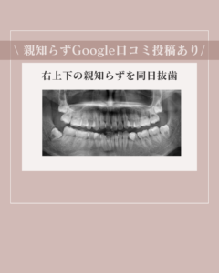親知らずの抜歯を同日にした写真
