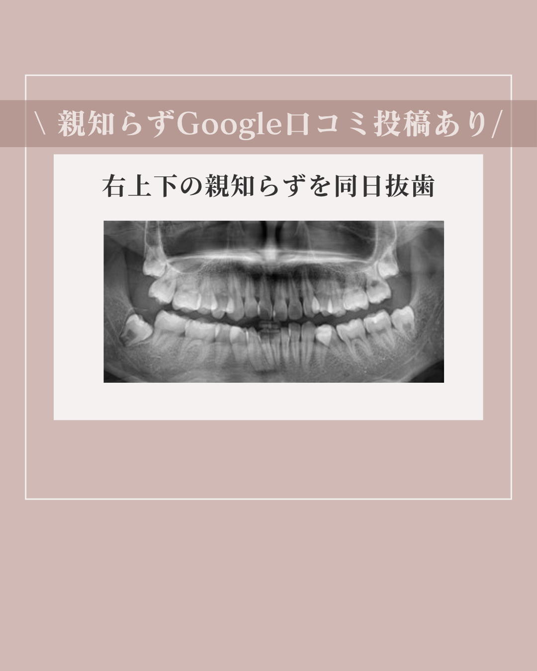 北新地で親知らずが腫れた方へ｜すぐ抜歯できる？受診の目安を解説