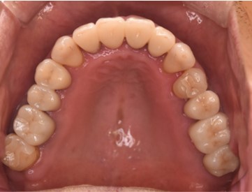 歯周病再生療法・補綴前矯正・ジルコニアクラウンによる総合治療後の口腔内写真①