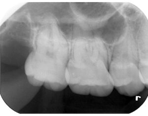 右上親知らずを約5分で抜歯した後の口腔内写真