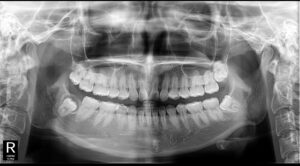 20代女性の右上親知らず抜歯前の口腔内写真